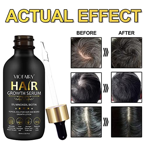 5% Minoxidil for Men and Women Hair Growth Oil Biotin Serum Hair Regrowth Treatment for Scalp Hair Loss Natural for Thicker Longer Fuller Healthier Hair 2.02 oz