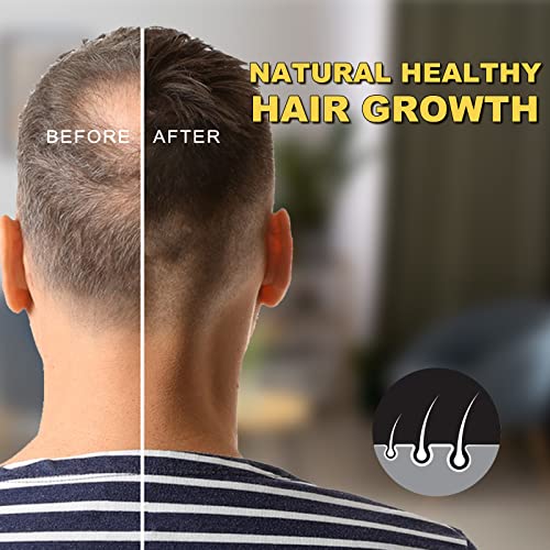 5% Minoxidil for Men and Women Hair Growth Oil Biotin Serum Hair Regrowth Treatment for Scalp Hair Loss Natural for Thicker Longer Fuller Healthier Hair 2.02 oz